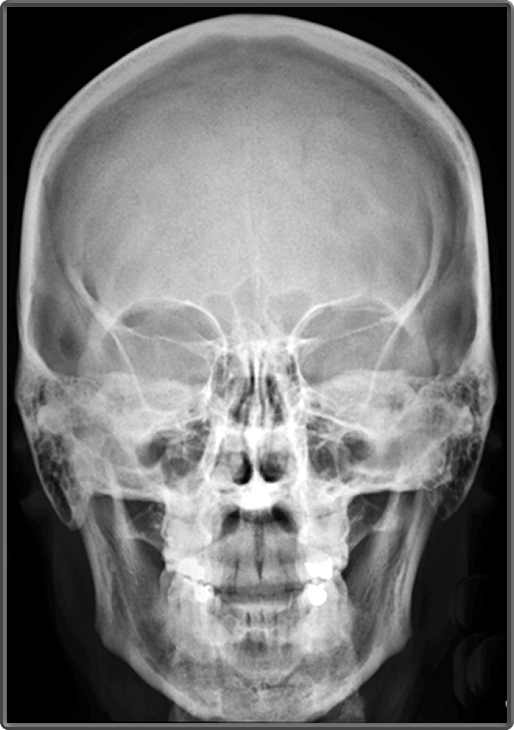 X Ray Skull Anatomy